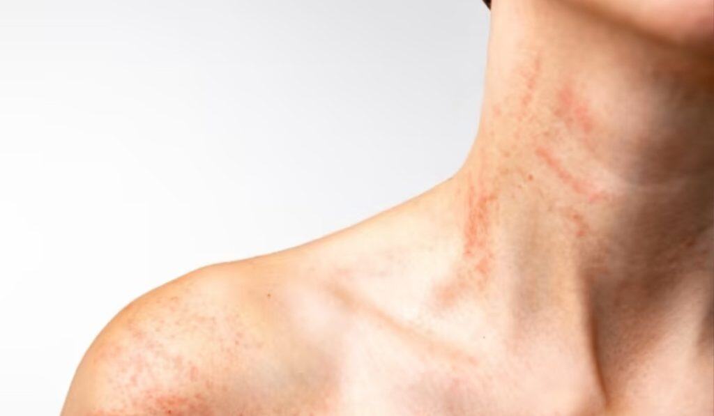 Zonneallergie: alles wat je moet weten over huidreacties door de zon