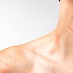 Zonneallergie: alles wat je moet weten over huidreacties door de zon