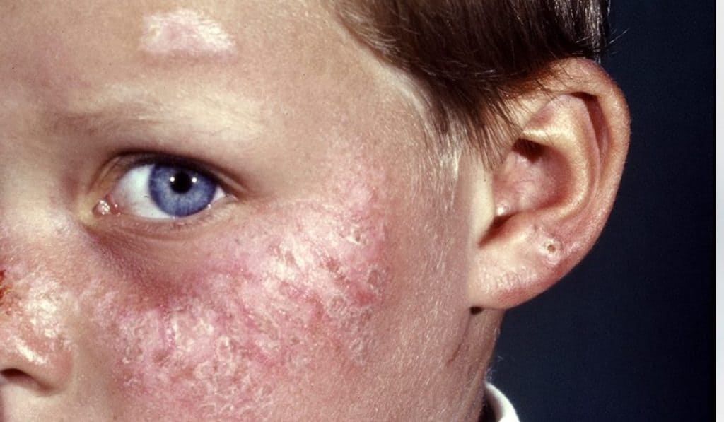 Alles over Zonneallergie, Warmteallergie en Warmtebultjes bij Baby’s en Kinderen