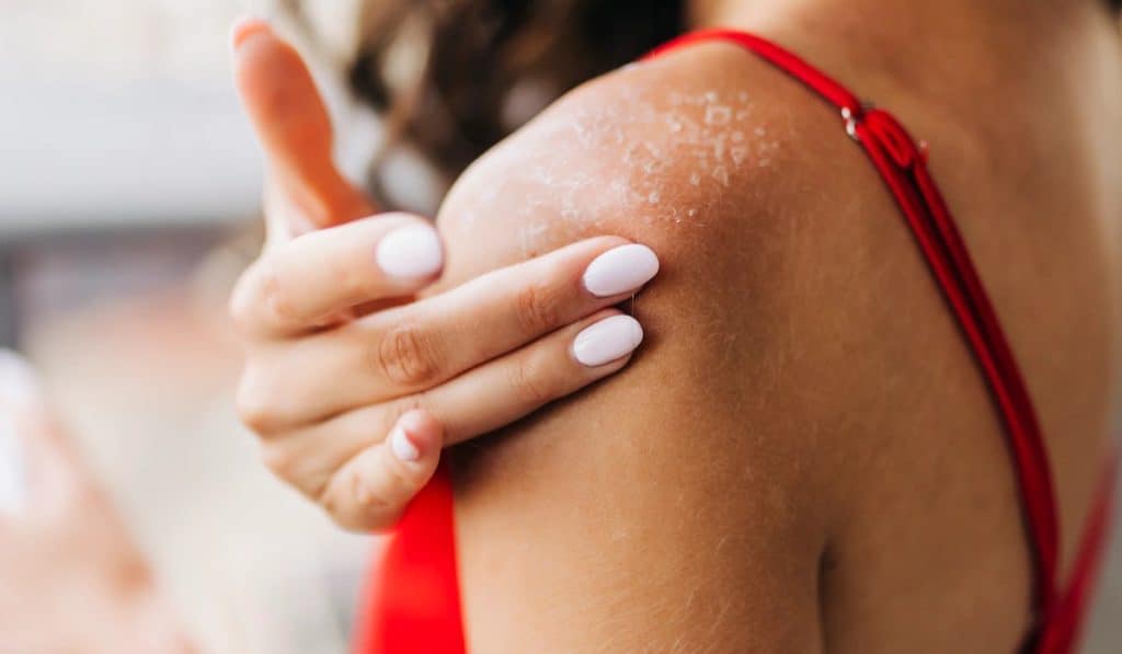 Alles over Zonneallergie