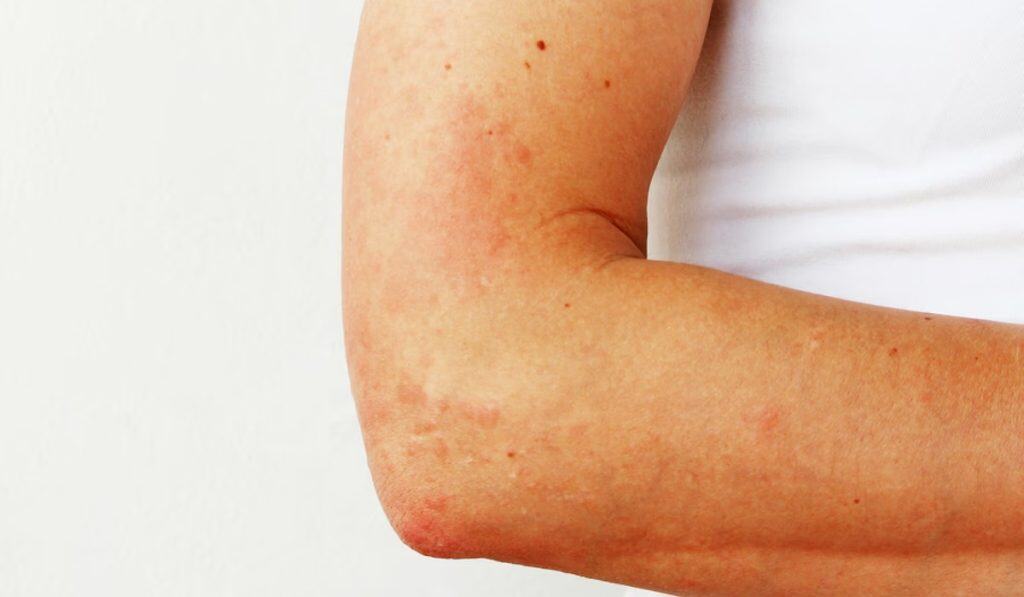 Alles over Zonneallergie