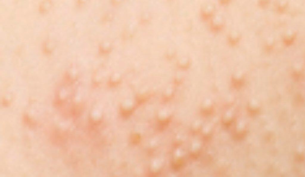 Warmtebultjes: Wat Zijn Ze en Hoe Herken Je Ze?