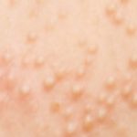 Warmtebultjes: Wat Zijn Ze en Hoe Herken Je Ze?