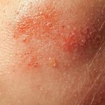 Zonneallergie en Warmte Uitslag