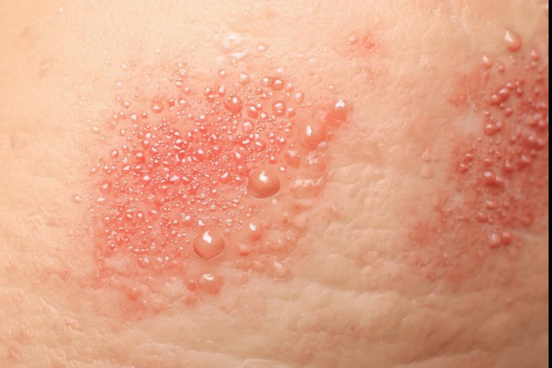 Zonneallergie en Warmte Uitslag