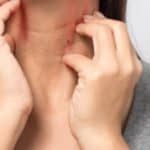 Keltisch Zeezout en Zonneallergie Gezondheid Verzorging Tips en Advies