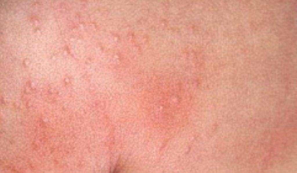 Zonneallergie en Warmtebultjes: Wat Je Moet Weten en Hoe Je Ze Kunt Behandelen