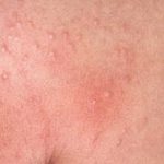 Zonneallergie en Warmtebultjes: Wat Je Moet Weten en Hoe Je Ze Kunt Behandelen