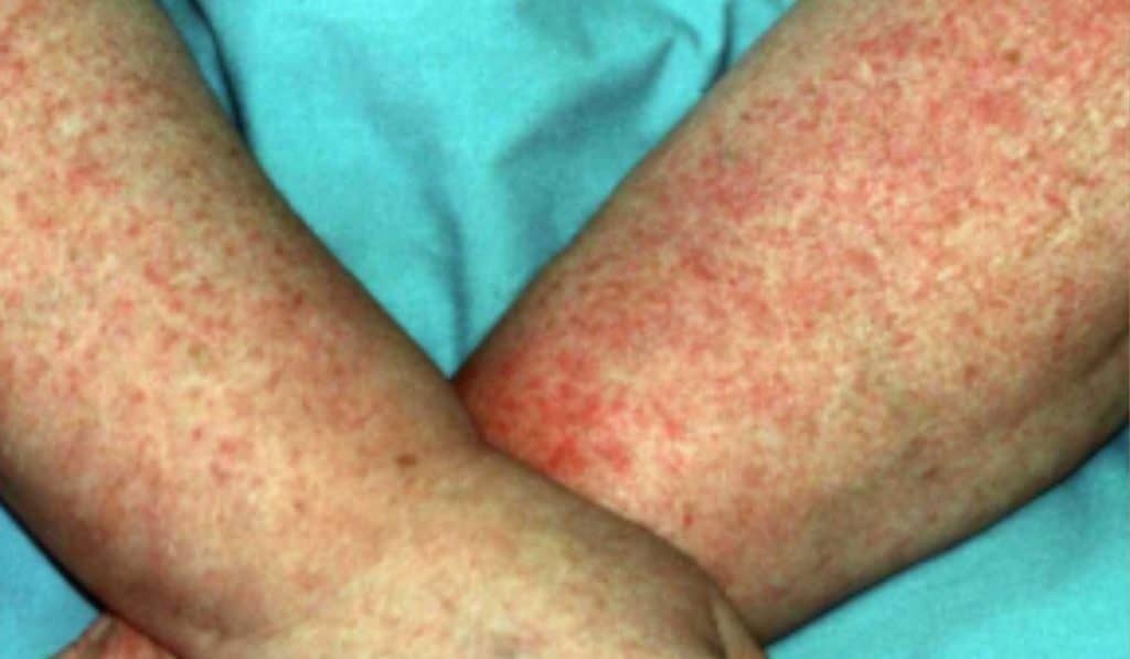 Zonneallergie en Warmtebultjes