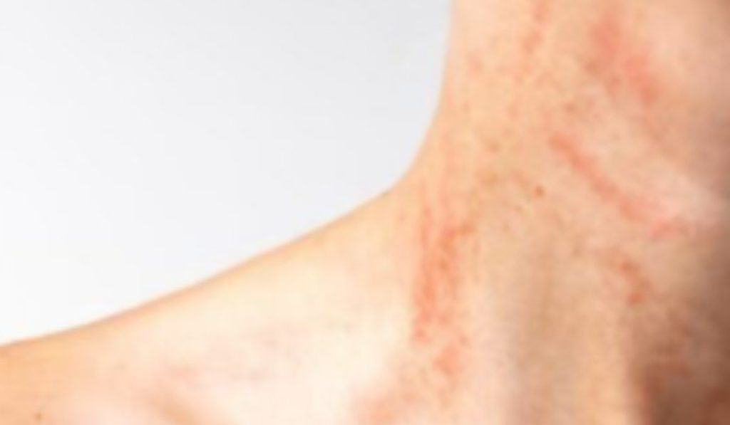 Zonneallergie en Warmtebultjes