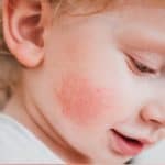 Warmtebultjes en Zonneallergie: Oorzaken, Symptomen en Behandeling