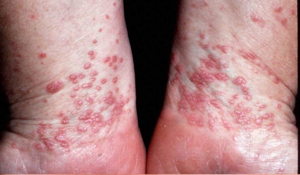 Warmtebultjes en Zonneallergie