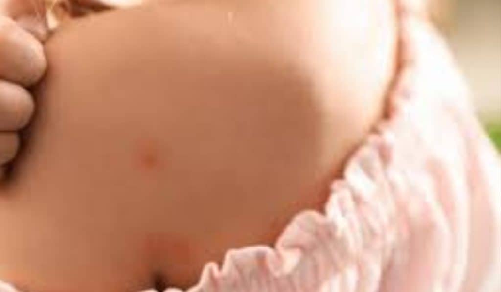 Muggenbeet Voorkomen De Ultieme Gids voor Binnen en Buiten