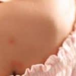 Muggenbeet Voorkomen De Ultieme Gids voor Binnen en Buiten