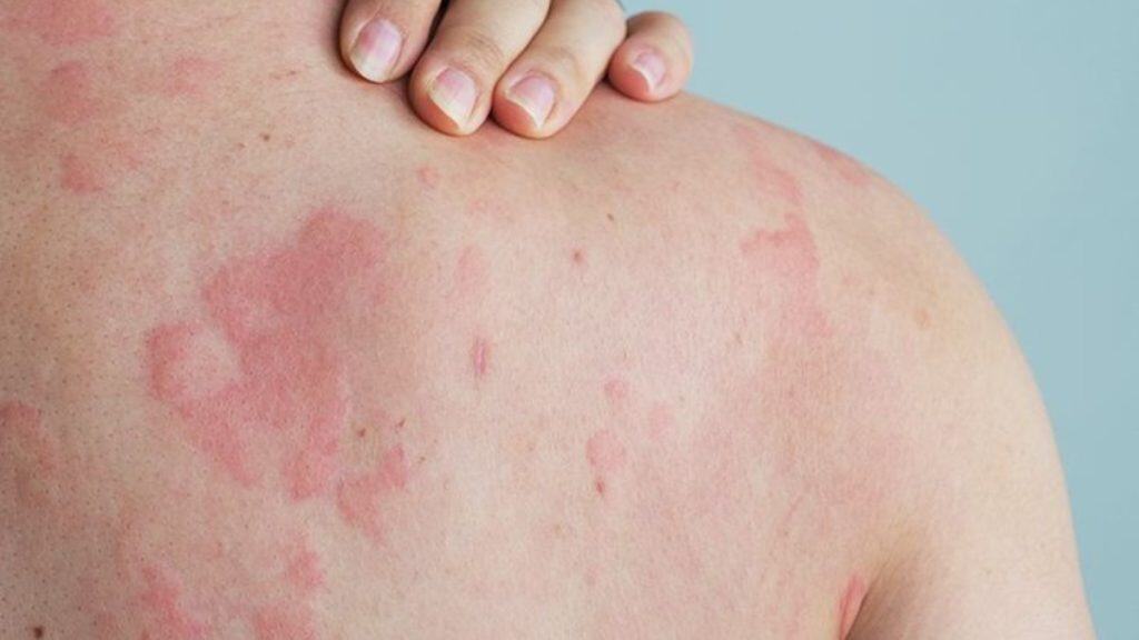 Warmtebultjes voorkomen en genezen lees alles over de symptomen en de behandeling