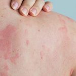 Warmtebultjes voorkomen en genezen lees alles over de symptomen en de behandeling