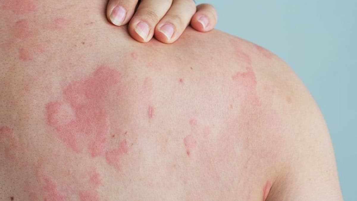 Warmtebultjes voorkomen en genezen lees alles over de symptomen en de behandeling