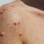 Welke oma tips werken echt bij zonneallergie bekijk de gids met alle remedies nu zelf