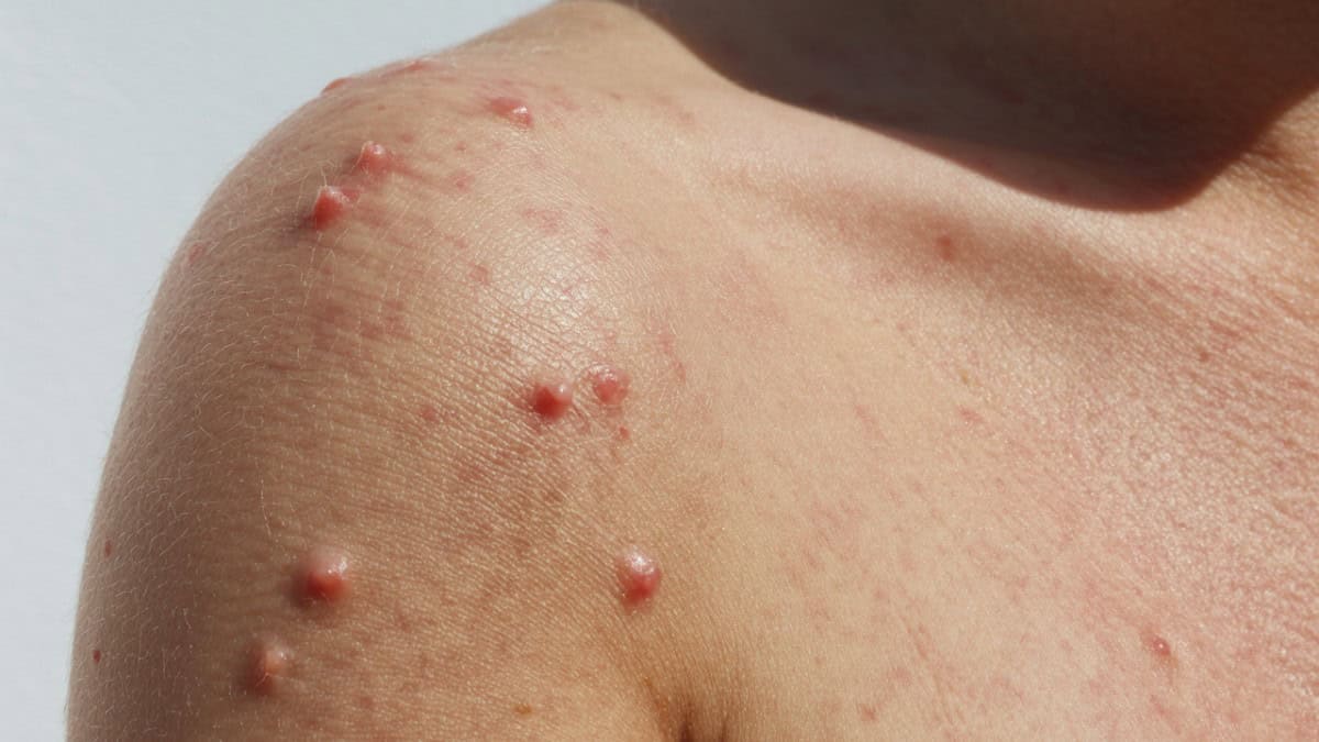 Welke oma tips werken echt bij zonneallergie bekijk de gids met alle remedies nu zelf