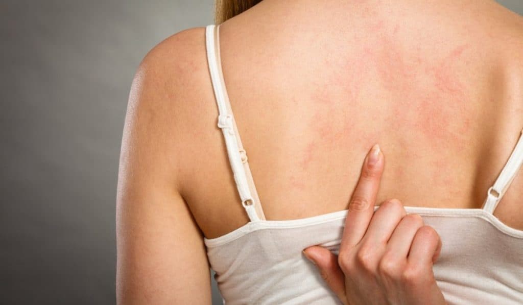 Zonneallergie voorkomen