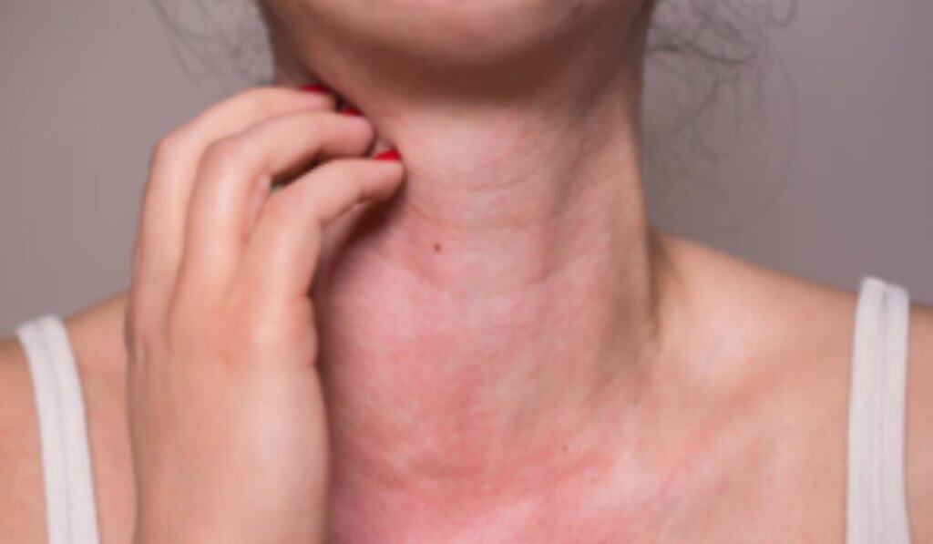 Zonneallergie voorkomen